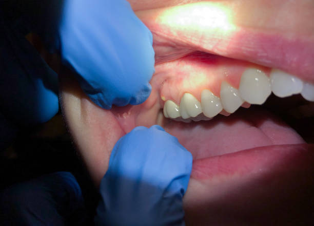 Best Emergency Wisdom Tooth Extraction in Tarkio, MO