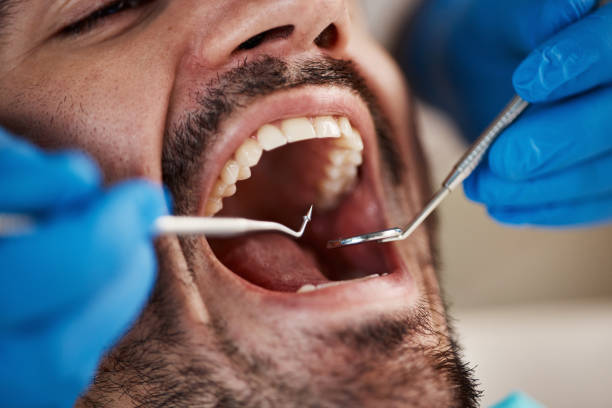 Best Knocked-Out Tooth (Avulsed Tooth) Treatment in Tarkio, MO